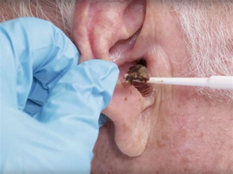 Video: Doctor removes earwax using nothing but water - Business Insider