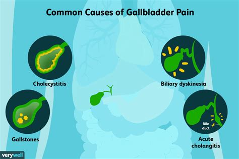 Gallbladder Pain: Causes, Treatment, and When to See a Doctor