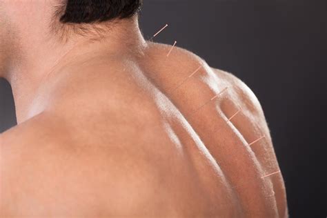 Dry Needling: A Time-Tested Treatment That Sticks It to Muscle Pain ...