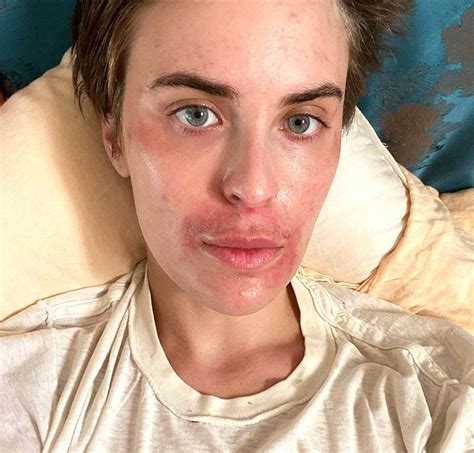 Tallulah Willis Gets Candid About Her Skin Struggles