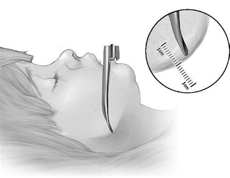 Side view of a child's face demonstrating laryngoscope blade placement ...