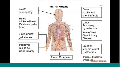 Principles of pain management and warning signs of sickle cell disease webinar - YouTube