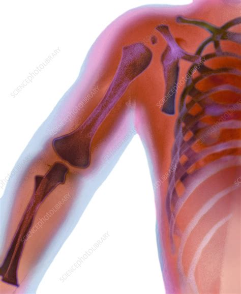 Fractured shoulder, X-ray - Stock Image - M330/1655 - Science Photo Library