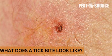 What Does a Tick Bite Look Like? - Pest Source