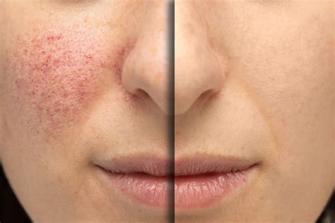 How to Calm a Rosacea Flare Up Fast | Affiliated Dermatology