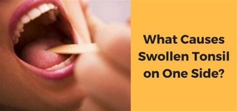 Swollen Tonsil on One Side: Possible Causes and Home Remedies