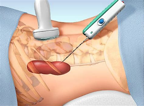 Procedure for percutaneous renal biopsy under ultrasound guidance | Vinmec