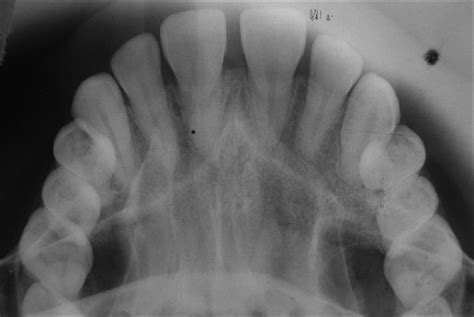 OCCLUSAL RADIOGRAPH 4 | buyxraysonline