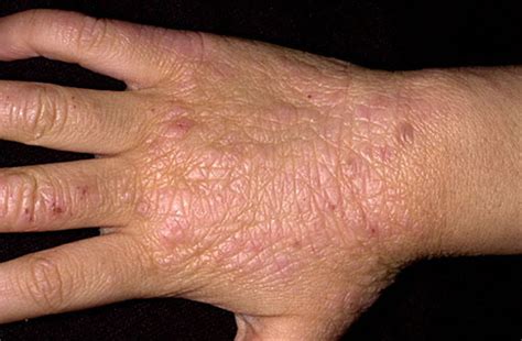 Lichen Planus Skin Rash