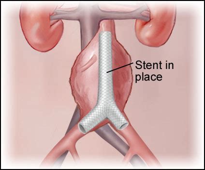 Abdominal Aortic Aneurysm Stent Graft