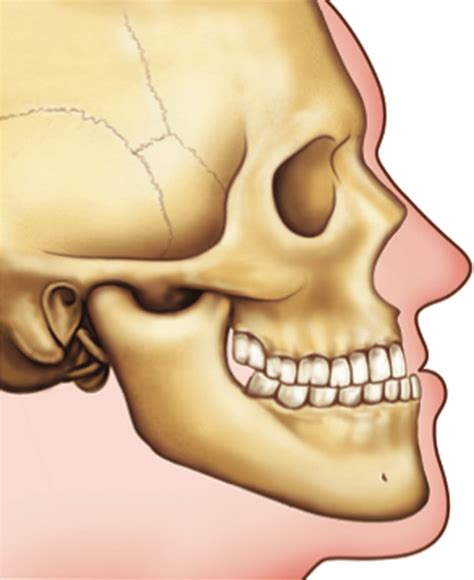 Mandibular Prognathism