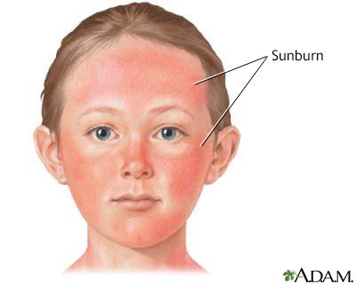 Sunburn Information | Mount Sinai - New York