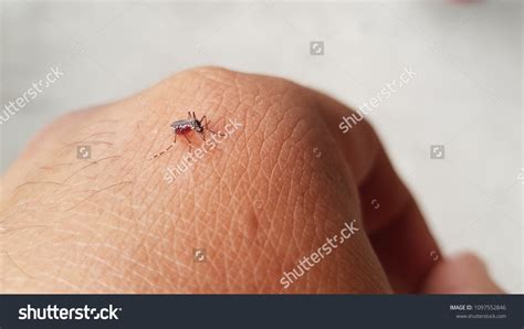 Mosquito Bite Human Skin Stock Photo 1097552846 | Shutterstock