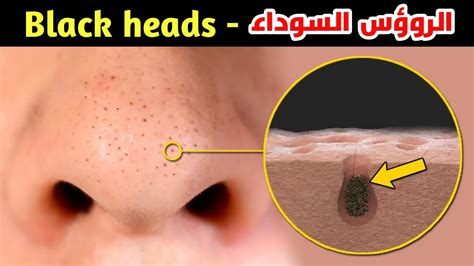 ما الذي يسبب الرؤوس السوداء على بشرتنا؟ الأسباب والعلاج _ ?What Causes ...