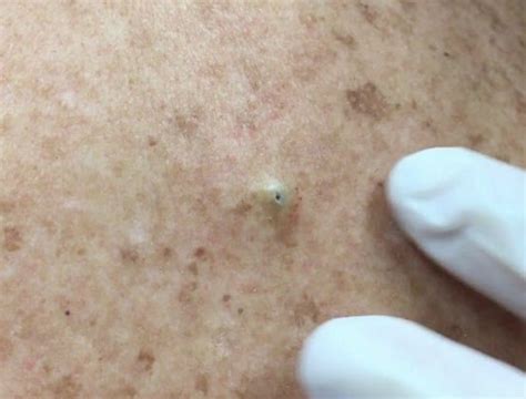 Watch: Dr Pimple Popper cyst removal after 10 years.