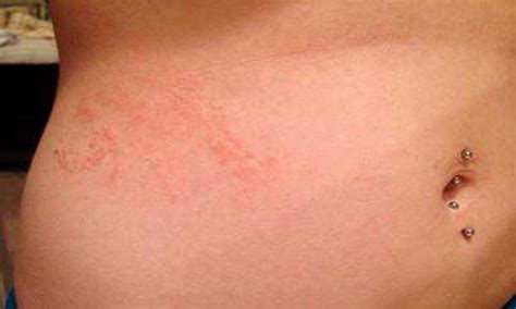 What Are Scabies Rash Treatment Symptoms Pictures - vrogue.co