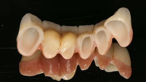 Zirconia Bridge Technique | Conservative Esthetic Tooth Replacement