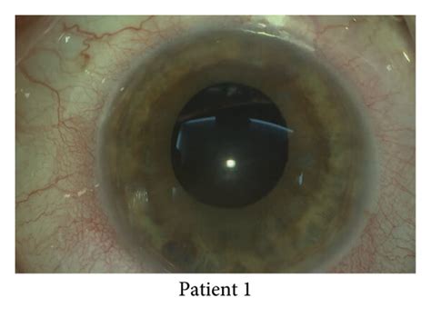 Patient 1: (a) preoperative aphakia with some degree of correctopia and... | Download Scientific ...