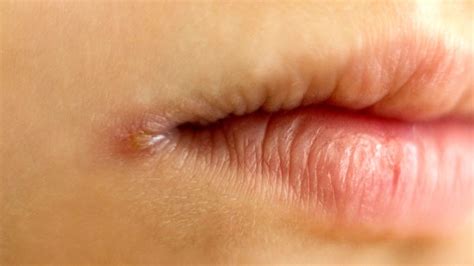 Angular Cheilitis: Images and Treatment - GoodRx