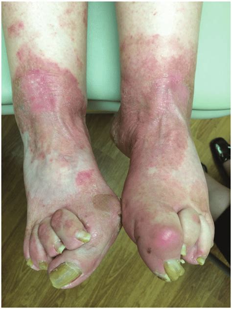 Erythematous scaly plaques due to tinea pedis. | Download Scientific Diagram