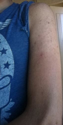 Acne On My Arms Is This Kp? - General acne discussion - Acne.org