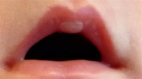 Blister On Baby Lip: Causes, Treatments And More