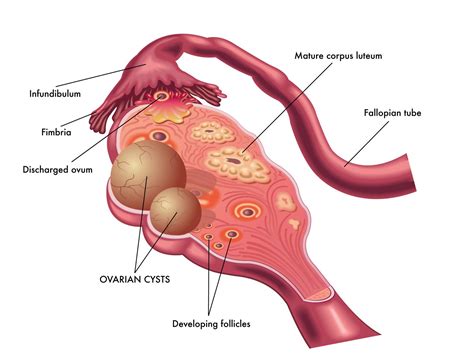 PCOS - NeslihanClae