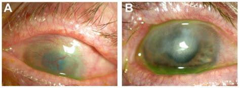 Superior Limbic Keratoconjunctivitis-like Inflammation in Patients with Chronic Graft-Versus ...