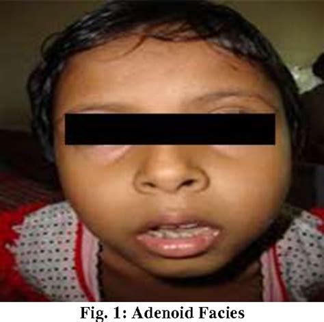 Figure 1 from Adenoid Facies and its Management: An Orthodontic Perspective | Semantic Scholar