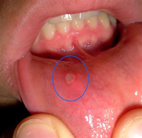 Canker Sores | Causes and Prevention - Dr. Dana Walters