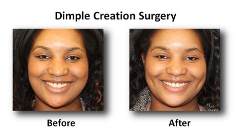 Dimple Creation Surgery Before And After