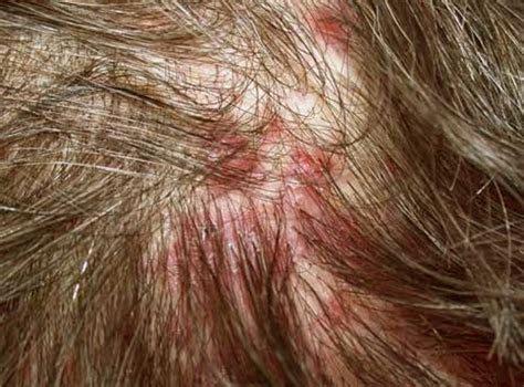 What Causes Bumps On Scalp