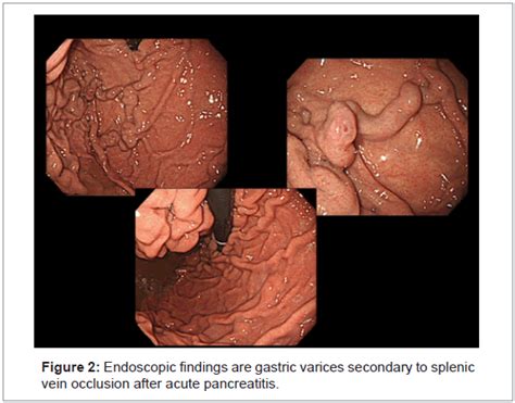 pancreatic-disorders-therapy-gastric-varices