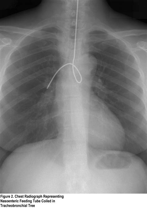 Nasogastric (NG) Tube Placement - Oxford Medical Education