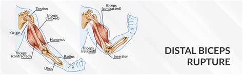 Distal Biceps Rupture - Dr. Saurabh Aggarwal