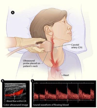 Carotid Ultrasound - Cardiac Specialists