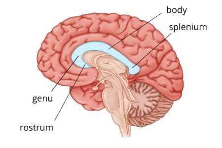 Corpus Callosum Stroke: Causes, Effects, & Treatment