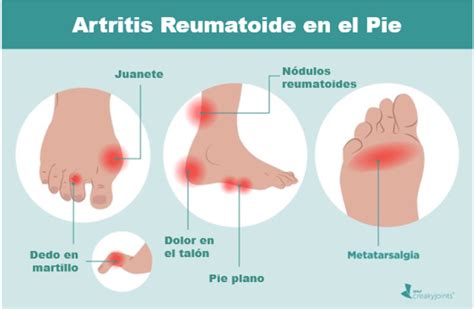 Artritis reumatoide y tus pies (y 6 maneras de mantenerlos saludables) - CreakyJoints