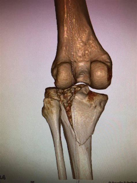 Tibial Plateau Fractures - what are they and how they can be treated