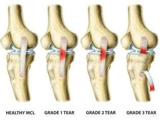 MCL Sprain Recovery Time - Injury Health Blog