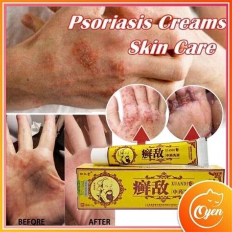 2 box Xuandi Cream Scabies Itching AntiFungus Ringworm Parasites Psoriasis Skin | eBay