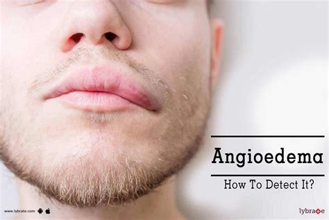 Angioedema Lips Natural Treatment | Lipstutorial.org