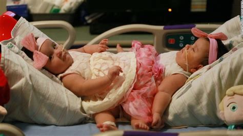 Conjoined Twins Fast Facts - CNN.com