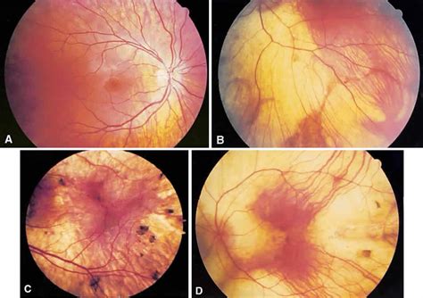 Choroideremia: rare X-linked, dystrophy- bilateral & symmetric nyctalopia, peripheral vf ...