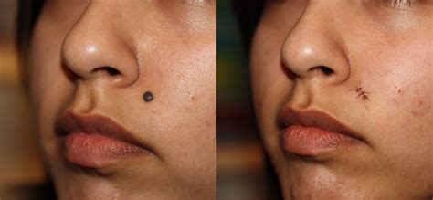 Mole Removal Prices, Costs | Skin Surgery Laser Clinic