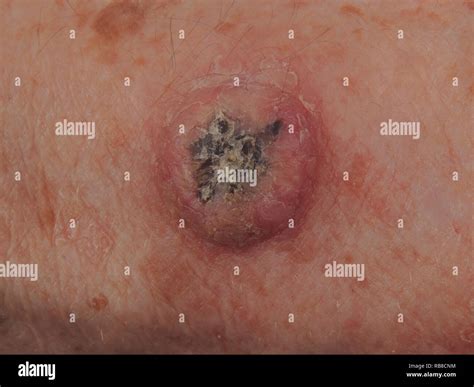 Squamous Cell Carcinoma Lesions