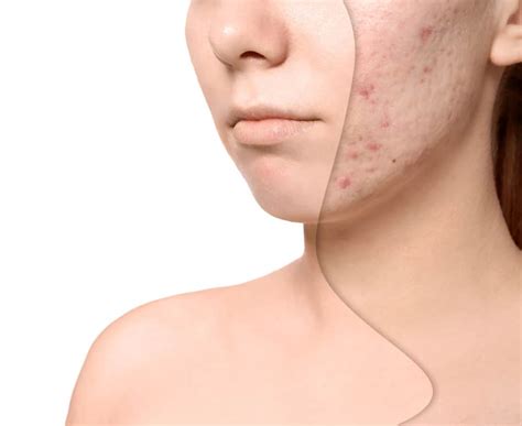 Acne Scar Removal Singapore | Pimple Scar, Acne Mark Treatment