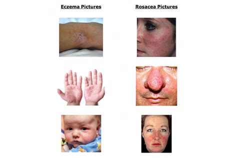 The Difference Between Rosacea & Eczema - Parents World