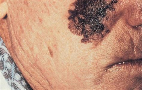 Melanoma Pictures: What does Melanoma look like?