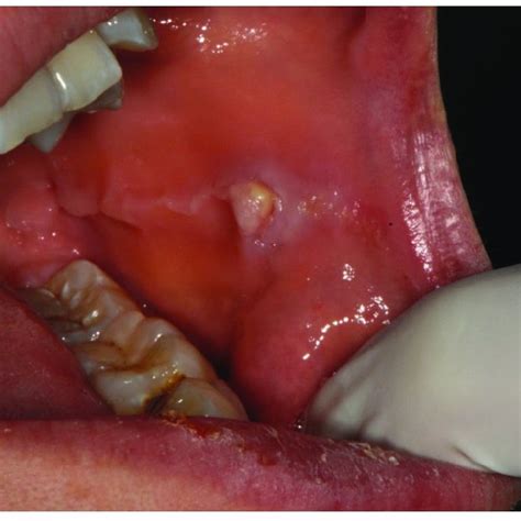 Initial clinical aspect showing mucopurulent discharge from the upper... | Download Scientific ...